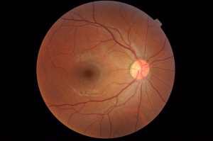 By OptometrusPrime (Fundus Photo, Right Eye (OD)) [CC BY-SA 2.0], via Wikimedia Commons