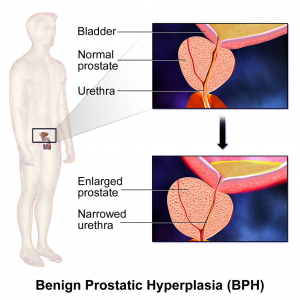 Benign_Prostatic_Hyperplasia_(BPH)