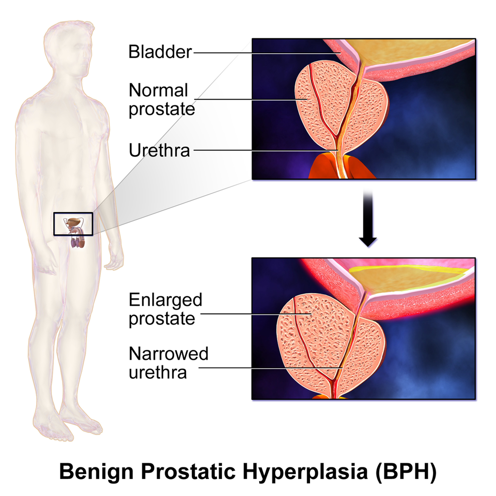 enlarged reduce how prostate Saw Supplements Palmetto Review  in  Testosterone for