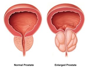 Prostate supplement guide illustration of enlarged prostate versus normal prostate