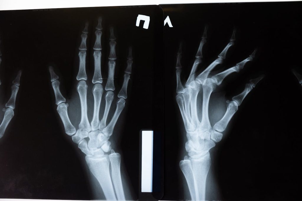 Image of x-ray scan of hands and bones inside hands.