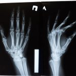 Image of x-ray scan of hands and bones inside hands.